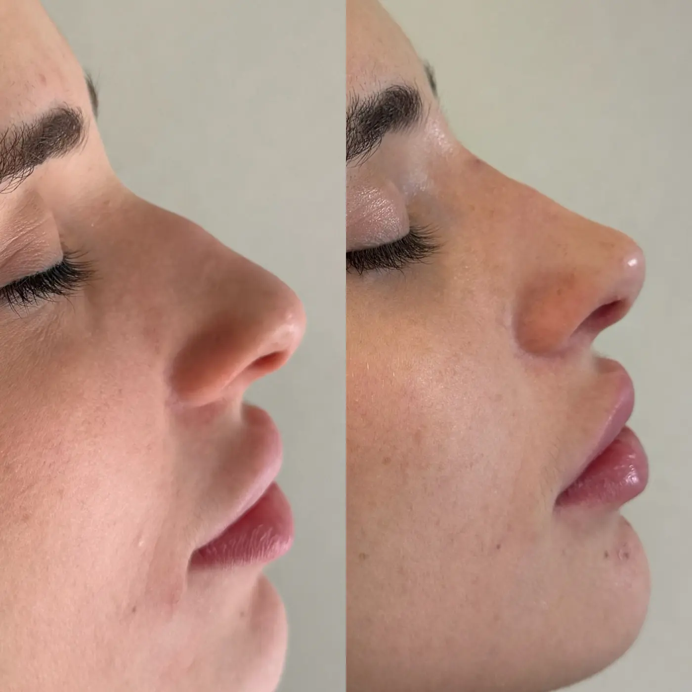 Harmonização Facial — resultado
