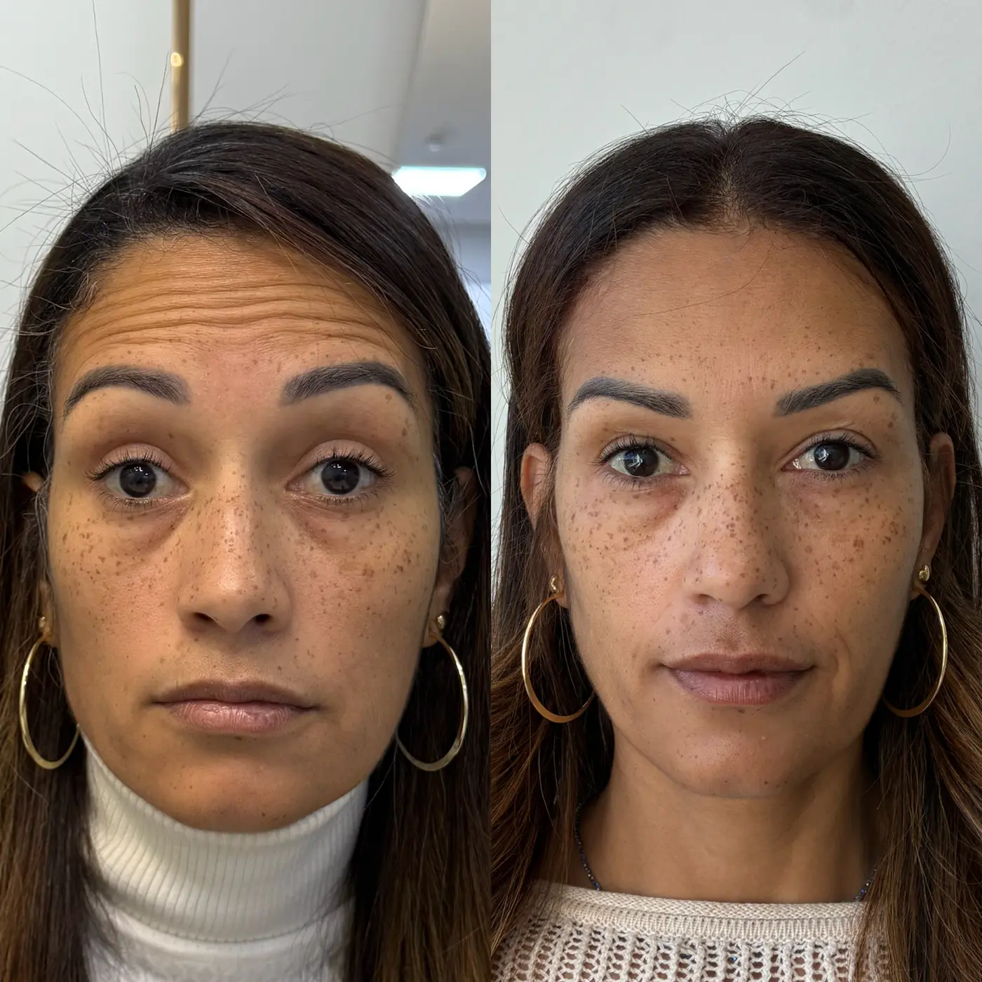 Harmonização Facial