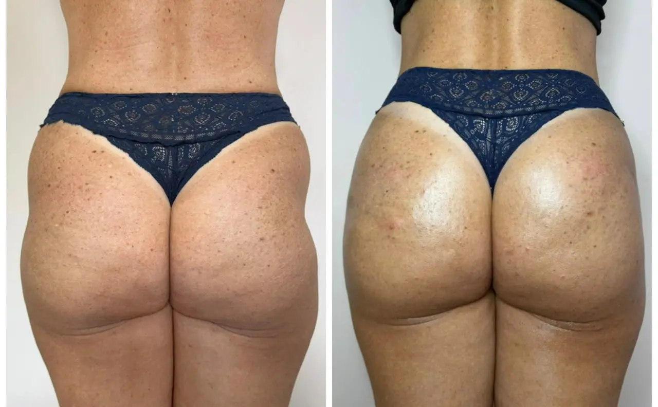 Bioestimulador Corporal — antes e depois